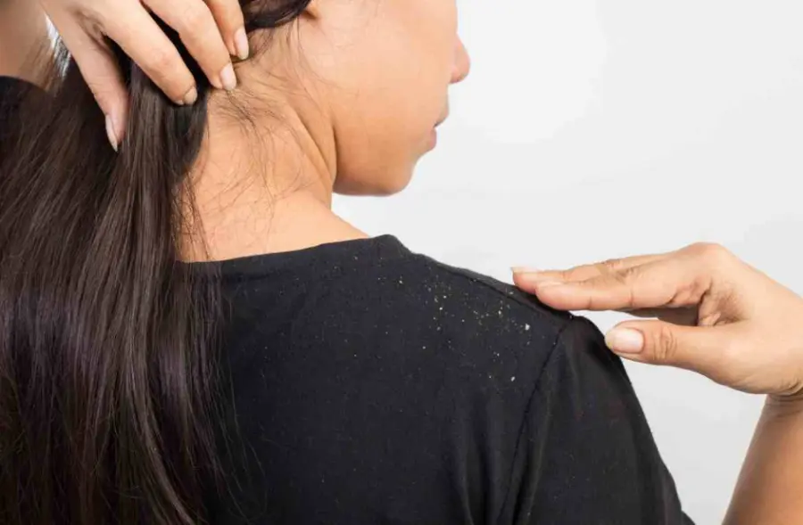 Rimedi naturali per la forfora