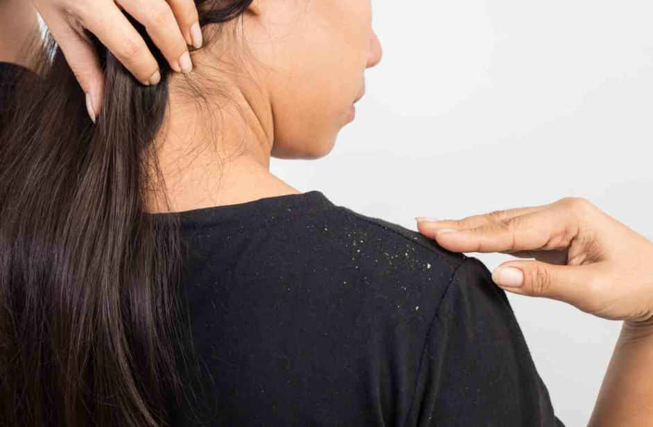 Rimedi naturali per la forfora